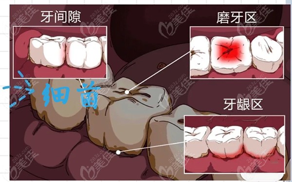 儿童初期蛀牙的样子图片
