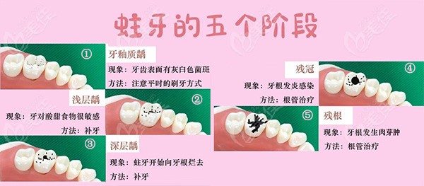 龋齿各个阶段图片
